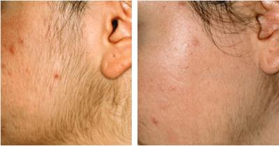Ipl-Laser-hair-removal