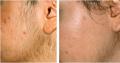 IPL Permanent Hair Removal For Men & Women