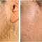 Ipl-Laser-hair-removal