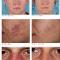 Ipl-before-after