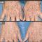 Skin-Rejuvenation-UVA