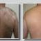 permanent-hair-removal