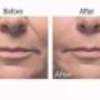 Botox2