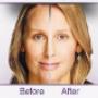 Botox