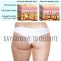 Cellulite Removal