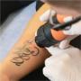 Tattoo Removal