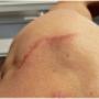 Scar Removal Cape Town