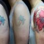 Tattoo Removal Cape Town