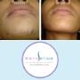 Chin laser