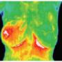 Breast cancer screening