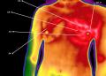 MediTherm