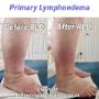 Primary Lymphoedema