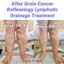 Secondary Lymphoedema after groin cancer