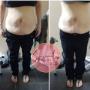 Laser Lipo