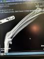 Custom Implant Development
