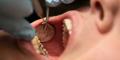 Dental-fillings