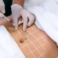 Lipolysis Injection