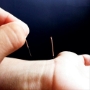 Acupuncture