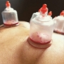 Cupping