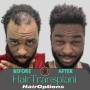 Hair Transplant
