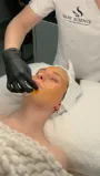 Chemical Peel